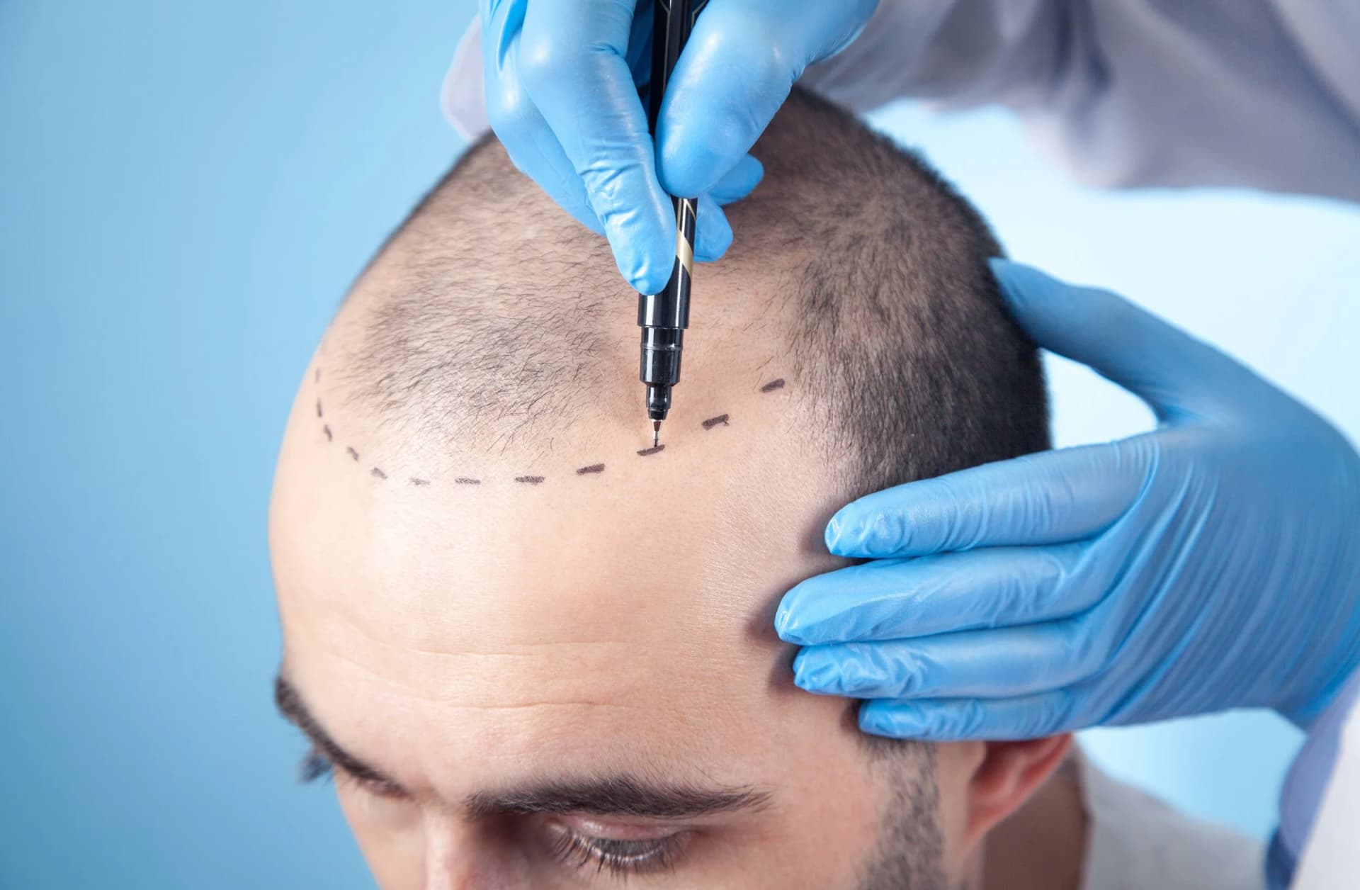 Men’s Hair Replacement That Matches Your Style