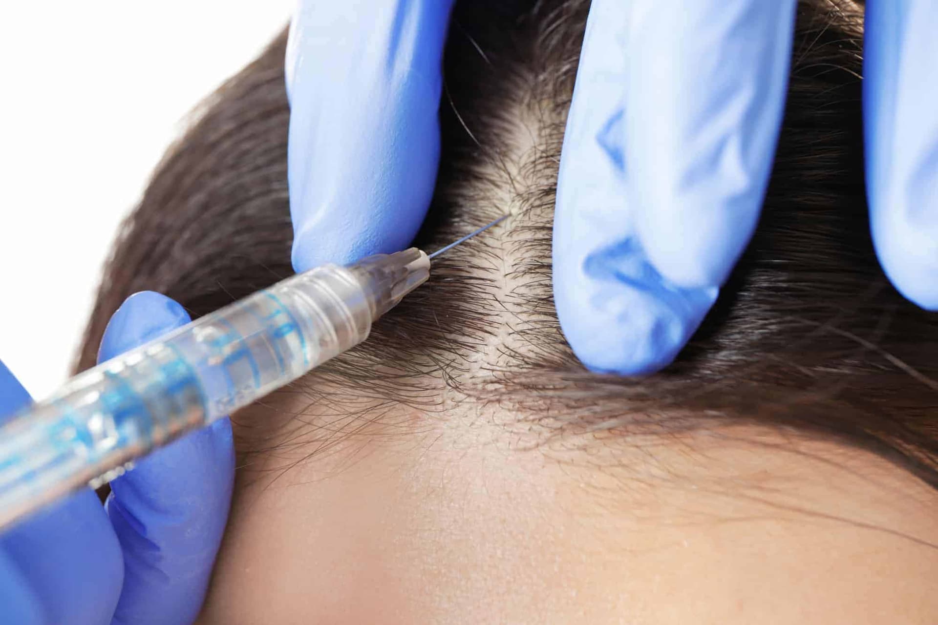 Hair transplant Turkey: Safe, Modern, and Effective